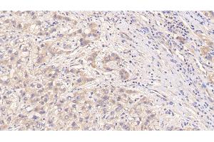 Detection of PIIINP in Human Liver cancer Tissue using Monoclonal Antibody to Procollagen III N-Terminal Propeptide (PIIINP) (PIIINP antibody)