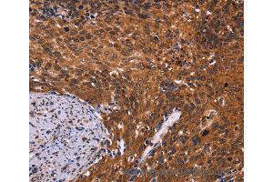 Immunohistochemistry of Human colon cancer using CDC5L Polyclonal Antibody at dilution of 1:40 (CDC5L antibody)