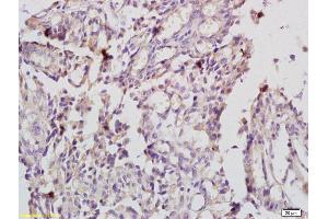 Formalin-fixed and paraffin embedded human endometrial cancer labeled with Anti-IL-20R alpha/IL20RA Polyclonal Antibody, Unconjugated (ABIN748103) at 1:200 followed by conjugation to the secondary antibody (IL20RA antibody  (AA 135-171))