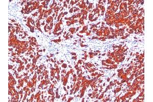 Formalin-fixed, paraffin-embedded human Breast Carcinoma stained with pan Cytokeratin Monoclonal Antibody cocktail (SPM115 + SPM116). (KRT77, KRT76 antibody)