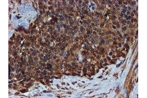 Immunohistochemical staining of paraffin-embedded Adenocarcinoma of Human breast tissue using anti-ENDOG mouse monoclonal antibody. (Endonuclease G antibody)