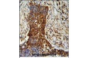 P2 antibody ABIN659015 iunohistochemistry analysis in formalin fixed and paraffin embedded human lung carcinoma followed by peroxidase conjμgation of the secondary antibody and DAB staining. (MMP2 antibody)