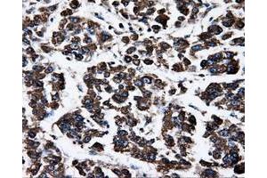 Immunohistochemical staining of paraffin-embedded Carcinoma of liver tissue using anti-ATP5Bmouse monoclonal antibody. (ATP5B antibody)