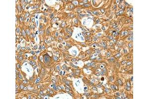 Immunohistochemical analysis of paraffin-embedded Human esophagus cancer tissue using at dilution 1/20. (Adenosine A3 Receptor antibody  (Internal Region))