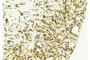 ABIN6269077 at 1/100 staining Human breast cancer tissue by IHC-P. (c-MYC antibody  (N-Term))