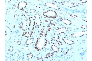 Formalin-fixed, paraffin-embedded human Renal Cell Carcinoma stained with PAX8 Monoclonal Antibody (PAX8/1491 + PAX8/1492).