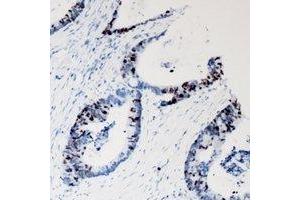 Immunohistochemical analysis of JNK1 staining in human colon cancer formalin fixed paraffin embedded tissue section.