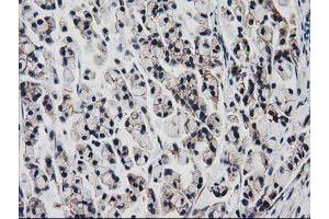 Immunohistochemical staining of paraffin-embedded Adenocarcinoma of Human colon tissue using anti-VCAM1 mouse monoclonal antibody. (VCAM1 antibody)