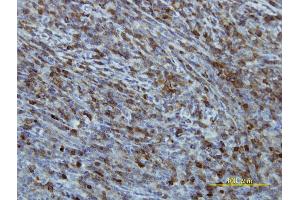Immunoperoxidase of monoclonal antibody to EIF2B2 on formalin-fixed paraffin-embedded human lymphoma tissue.