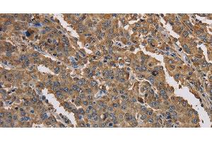Immunohistochemistry of paraffin-embedded Human liver cancer tissue using KCNG1 Polyclonal Antibody at dilution 1:40 (KCNG1 antibody)