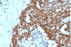 Formalin-fixed, paraffin-embedded human ovarian carcinoma stained with Nucleolin antibody. (Nucleolin antibody)