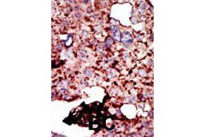 Formalin-fixed and paraffin-embedded human breast cancer tissue reacted with HK1 polyclonal antibody  , which was peroxidase-conjugated to the secondary antibody, followed by DAB staining.
