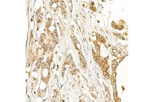 Immunohistochemistry of paraffin-embedded human colon carcinoma using KLK1 Rabbit pAb (ABIN3022581, ABIN3022582, ABIN3022583 and ABIN6218920) at dilution of 1:500 (40x lens). (Kallikrein 1 antibody  (AA 25-262))
