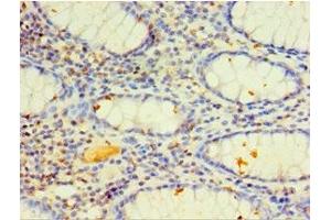 Immunohistochemistry of paraffin-embedded human colon cancer using ABIN7149272 at dilution of 1:100 (CYP4F12 antibody  (AA 265-524))