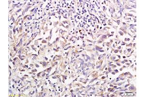 Formalin-fixed and paraffin embedded human gastric cancer labeled with Anti-SHH Polyclonal Antibody, Unconjugated (ABIN731108) followed by conjugation to the secondary antibody and DAB staining (Sonic Hedgehog antibody  (AA 21-120))