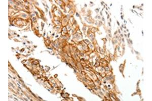 The image on the left is immunohistochemistry of paraffin-embedded Human cervical cancer tissue using ABIN7192777(TGM1 Antibody) at dilution 1/25, on the right is treated with synthetic peptide. (TGM1 antibody)