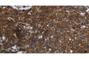 Immunohistochemistry of paraffin-embedded Human cervical cancer using FASTKD2 Polyclonal Antibody at dilution of 1:45 (FASTKD2 antibody)
