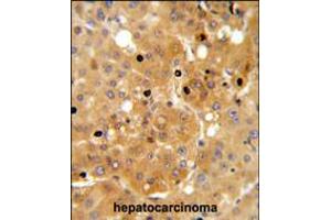 PRKAA1 Antibody IHC analysis in formalin fixed and paraffin embedded human hepatocarcinoma followed by peroxidase conjugation of the secondary antibody and DAB staining. (PRKAA1 antibody)