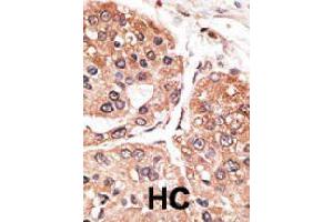 Formalin-fixed and paraffin-embedded human hepatocellular carcinoma tissue reacted with SMYD5 polyclonal antibody  , which was peroxidase-conjugated to the secondary antibody, followed by DAB staining. (SMYD5 antibody  (C-Term))