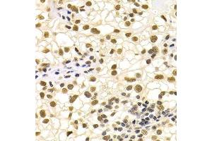 Immunohistochemistry of paraffin-embedded human kidney cancer using DDB1 Antibody. (DDB1 antibody)