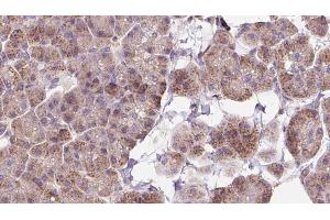 ABIN6273263 at 1/100 staining Human pancreas cancer tissue by IHC-P. (EIF2D antibody  (Internal Region))