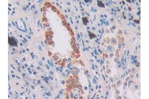 Detection of IFI16 in Human Lung cancer Tissue using Polyclonal Antibody to Interferon Gamma Inducible Protein 16 (IFI16) (IFI16 antibody  (AA 465-671))