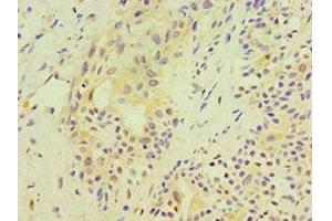 Immunohistochemistry of paraffin-embedded human breast cancer using ABIN7170540 at dilution of 1:100 (Spermidine Synthase antibody  (AA 1-302))