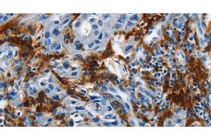Immunohistochemistry of paraffin-embedded Human lung cancer tissue using IL20RA Polyclonal Antibody at dilution 1:35 (IL20RA antibody)