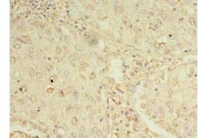 Immunohistochemistry of paraffin-embedded human lung cancer using ABIN7162276 at dilution of 1:100 (ORMDL1 antibody  (AA 48-100))