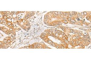 Immunohistochemistry of paraffin-embedded Human gastric cancer tissue using GNB1L Polyclonal Antibody at dilution of 1:35(x200) (GNB1L antibody)