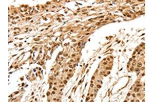 The image on the left is immunohistochemistry of paraffin-embedded Human esophagus cancer tissue using ABIN7192627(SPATA20 Antibody) at dilution 1/70, on the right is treated with synthetic peptide. (SPATA2 antibody)