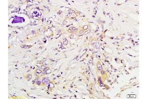 Formalin-fixed and paraffin embedded human colon carcinoma tissue labeled with Anti-Tsg101 Polyclonal Antibody , Unconjugated at 1:200 followed by conjugation to the secondary antibody, (SP-0023), and DAB staining