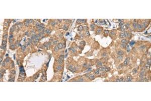 Immunohistochemistry of paraffin-embedded Human thyroid cancer tissue using BCHE Polyclonal Antibody at dilution of 1:40(x200) (Butyrylcholinesterase antibody)