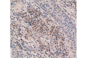 Used in DAB staining on fromalin fixed paraffin- embedded skin cancer tissue (CASP5 antibody  (AA 145-327))