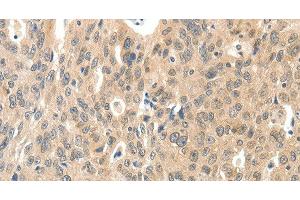 Immunohistochemistry of paraffin-embedded Human ovarian cancer tissue using ROS1 Polyclonal Antibody at dilution 1:40 (ROS1 antibody)