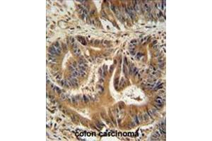 VPS52 antibody (C-term) immunohistochemistry analysis in formalin fixed and paraffin embedded human colon carcinoma followed by peroxidase conjugation of the secondary antibody and DAB staining. (VPS52 antibody  (C-Term))