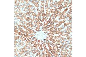Immunohistochemistry of paraffin-embedded human colon carcinoma using SLC39 antibody (ABIN1682781, ABIN3017803, ABIN3017805 and ABIN6220263) at dilution of 1:100 (40x lens). (SLC39A4 antibody  (AA 23-327))