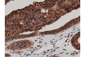 Immunohistochemical staining of paraffin-embedded Adenocarcinoma of Human ovary tissue using anti-DNAJA2 mouse monoclonal antibody.