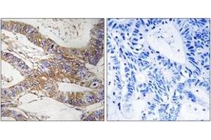 Immunohistochemistry analysis of paraffin-embedded human colon carcinoma tissue, using SERPINB9 Antibody. (SERPINB9 antibody  (AA 241-290))