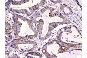 IHC testing of FFPE human intestinal cancer tissue with Calpastatin antibody at 1ug/ml. (Calpastatin antibody  (AA 275-310))
