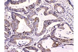 IHC testing of FFPE human intestinal cancer tissue with Calpastatin antibody at 1ug/ml.