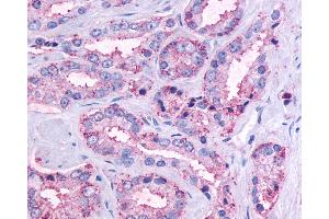 Anti-OR51E1 antibody IHC of human Prostate, Carcinoma.