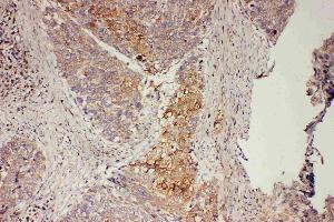 Anti-GRB7 antibody, IHC(P): Human Oesophagus Squama Cancer Tissue (GRB7 antibody  (Middle Region))