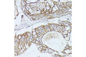 Immunohistochemistry of paraffin-embedded Human pancreatic ductal carcinoma using β-Catenin antibody (ABIN7266137) at dilution of 1:100 (40x lens). (CTNNB1 antibody)