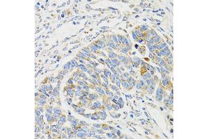 Immunohistochemistry of paraffin-embedded human esophageal cancer using SH2B1 Antibody (ABIN5973245) at dilution of 1/100 (40x lens). (SH2B1 antibody)