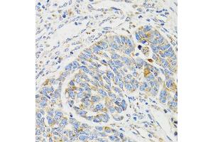 Immunohistochemistry of paraffin-embedded human esophageal cancer using SH2B1 Antibody (ABIN5973245) at dilution of 1/100 (40x lens).
