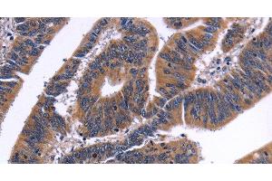 Immunohistochemistry of paraffin-embedded Human colon cancer tissue using NFATC3 Polyclonal Antibody at dilution 1:50 (NFATC3 antibody)