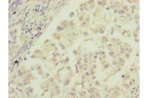 Immunohistochemistry of paraffin-embedded human lung cancer using ABIN7172905 at dilution of 1:100 (MTIF3 antibody  (AA 1-278))
