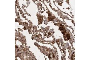 Immunohistochemical staining of human lung with ARL13A polyclonal antibody  shows strong cytoplasmic positivity in macrophages at 1:20-1:50 dilution.