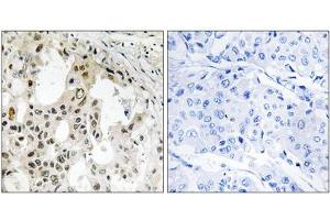 Immunohistochemistry analysis of paraffin-embedded human breast carcinoma tissue using EIF3D antibody.
